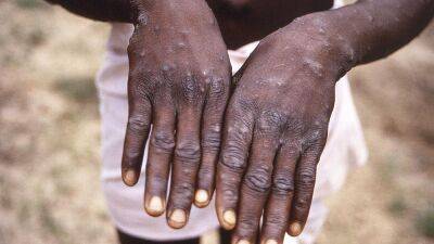 Europe at 'epicentre' of monkeypox outbreak, WHO says